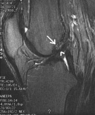 Subtle flattened axis as a primary sign of ACL tea