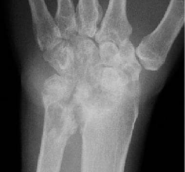 Follow-up radiograph obtained after an 18-month in