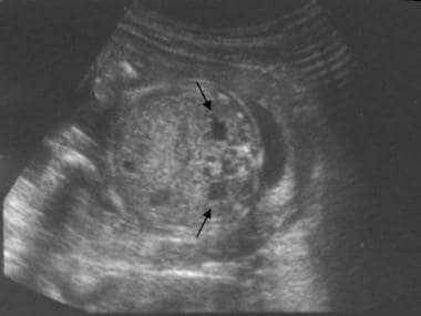 Axial prenatal ultrasonogram of the abdomen obtain