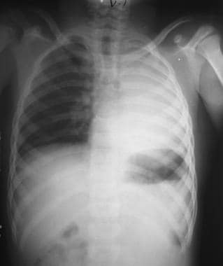 Chest radiograph in a 6-year-old boy who complaine