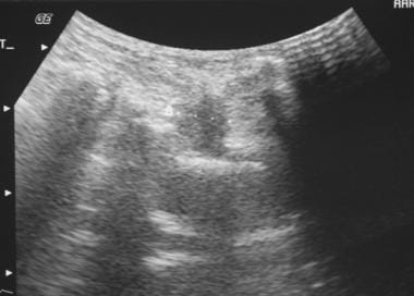Sonogram shows a small collection adjacent to the 