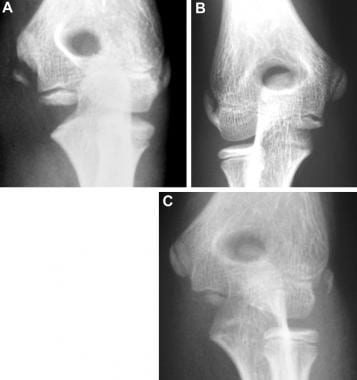 Medial epicondyle avulsion fracture in an 11-year-