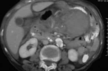 Case 4. CT scan obtained in a 45-year-old man with
