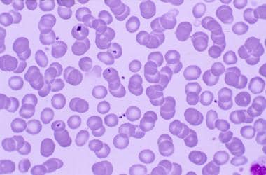 Malarial merozoites in the peripheral blood. Note 