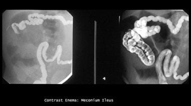 Enema study shows microcolon and contrast material
