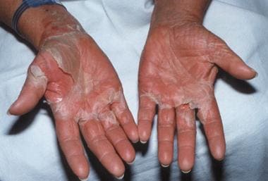 Erythroderma secondary to toxic shock syndrome.