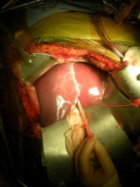 After clamping of the right hepatic artery and rig