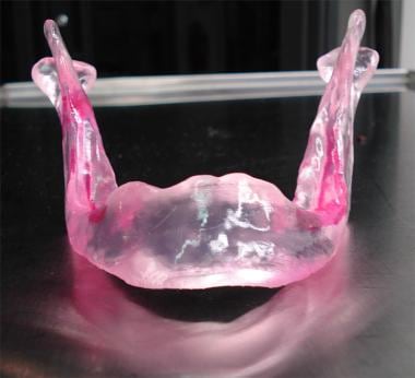 A model of the patient's mandible generated from t