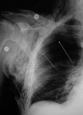 Pediatric Pneumothorax Workup: Approach Considerations, Chest Radiography