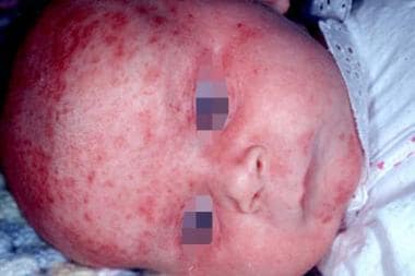 This child presented with petechial lesions, hepat