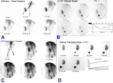Nuclear renograms of kidney transplantations. (A) 