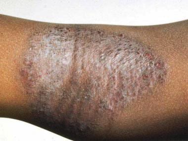 Atopic dermatitis. Flexural involvement in childho