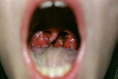 The exudative pharyngitis typical of scarlet fever