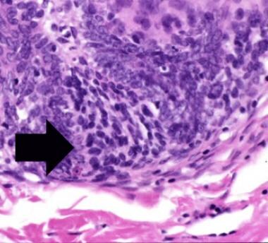 Papillary-mesenchymal bodies are structures associ