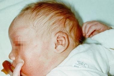 Neonate with oculocutaneous albinism type 3 presen