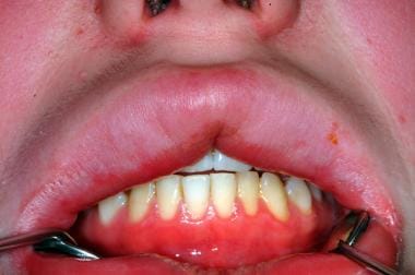 Orofacial granulomatosis in a patient with Crohn d