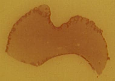 Epulis fissuratum Histologie