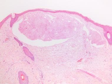 Hematoxylin and eosin–stained section of skin (X40