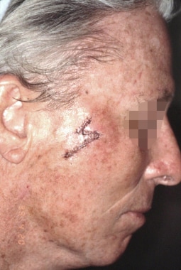 Reconstruction of the right cheek defect with a su