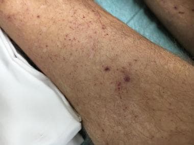 water moccasin bite mark