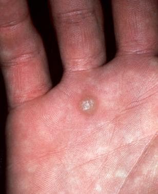 Common wart on the hand. 