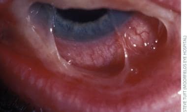 Pseudomembranes and conjunctival inflammation due 