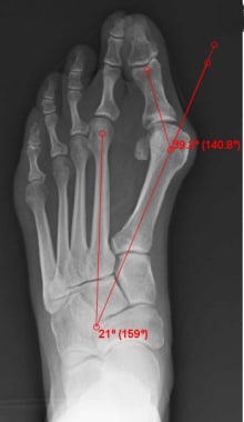 bunionectomy x ray