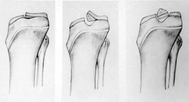 tibial intercondylar eminence