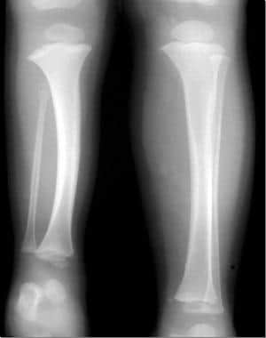 Postaxial Hypoplasia of Lower Extremity (Fibular Hemimelia) Workup ...