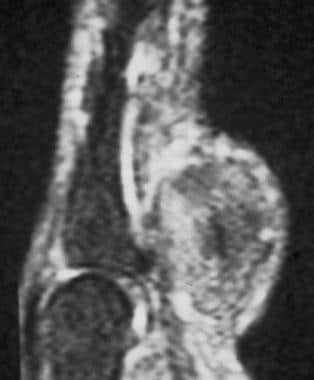 Typical T1-weighted MRI findings in a giant cell t