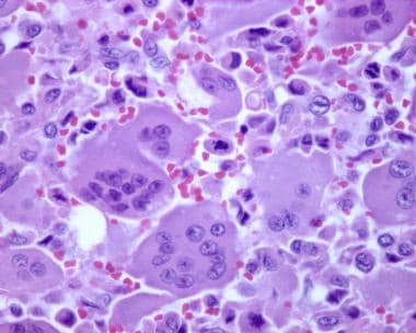 Photomicrograph of giant cell tumor reveals promin