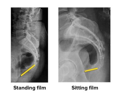 Dynamic radiographs obtained from patient with coc