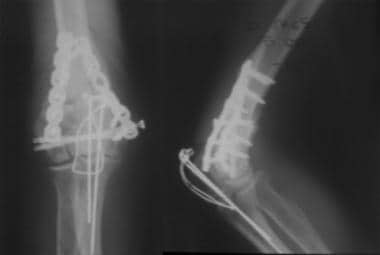 Radiographs of type 3C distal humerus fracture 5 m