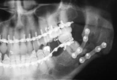 Mandibular fracture. Treated initially with a supe