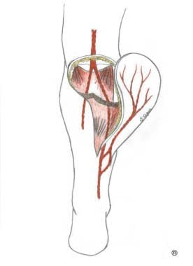 Sural flap; perforator flap from peroneal artery; 