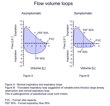 Vocal Cord Dysfunction