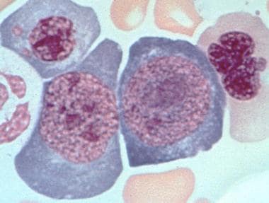Bone marrow aspirate from a patient with untreated