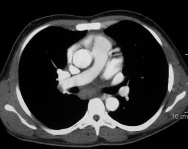 Contrast-enhanced axial CT scan in a child shows h