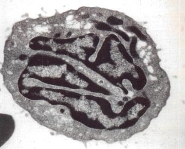 Electron micrograph of a Sézary cell. 