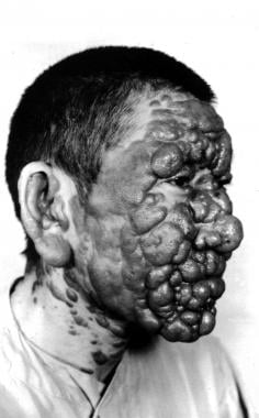 Post–kala-azar dermal leishmaniasis. Courtesy of R