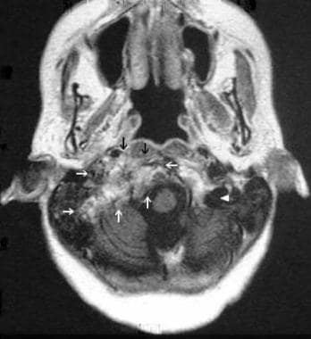 术前所示肿瘤的相应MRI