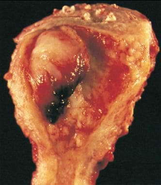 Adenocarcinoma of the endometrium. This tumor, whi