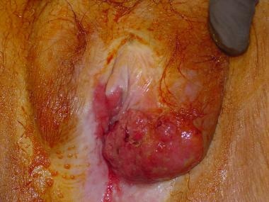 A large T2 carcinoma of the vulva crossing the mid