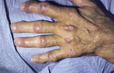 Nodules on a hand with deformed joints from arthri