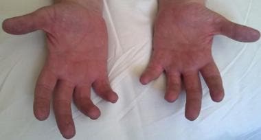 Hands of 29-year-old with advanced Charcot-Marie-T