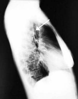 Lateral chest radiograph of a mediastinal mass fou