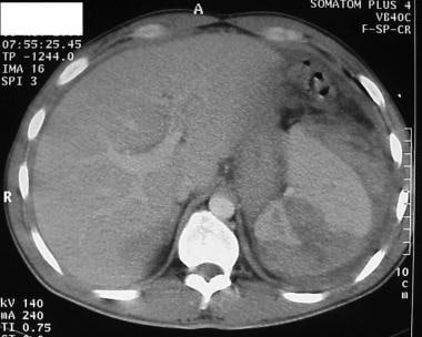 Grade 4-5 splenic laceration on helical CT scan. 