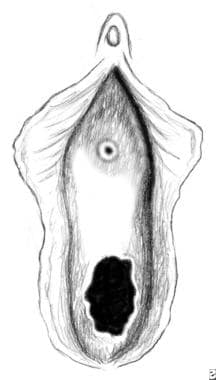 Urethral prolapse. Postoperative depiction of a no