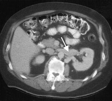 CT scan shows renal vein thrombosis secondary to r