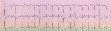 ECG shows frequent, unifocal PVCs with a fixed cou